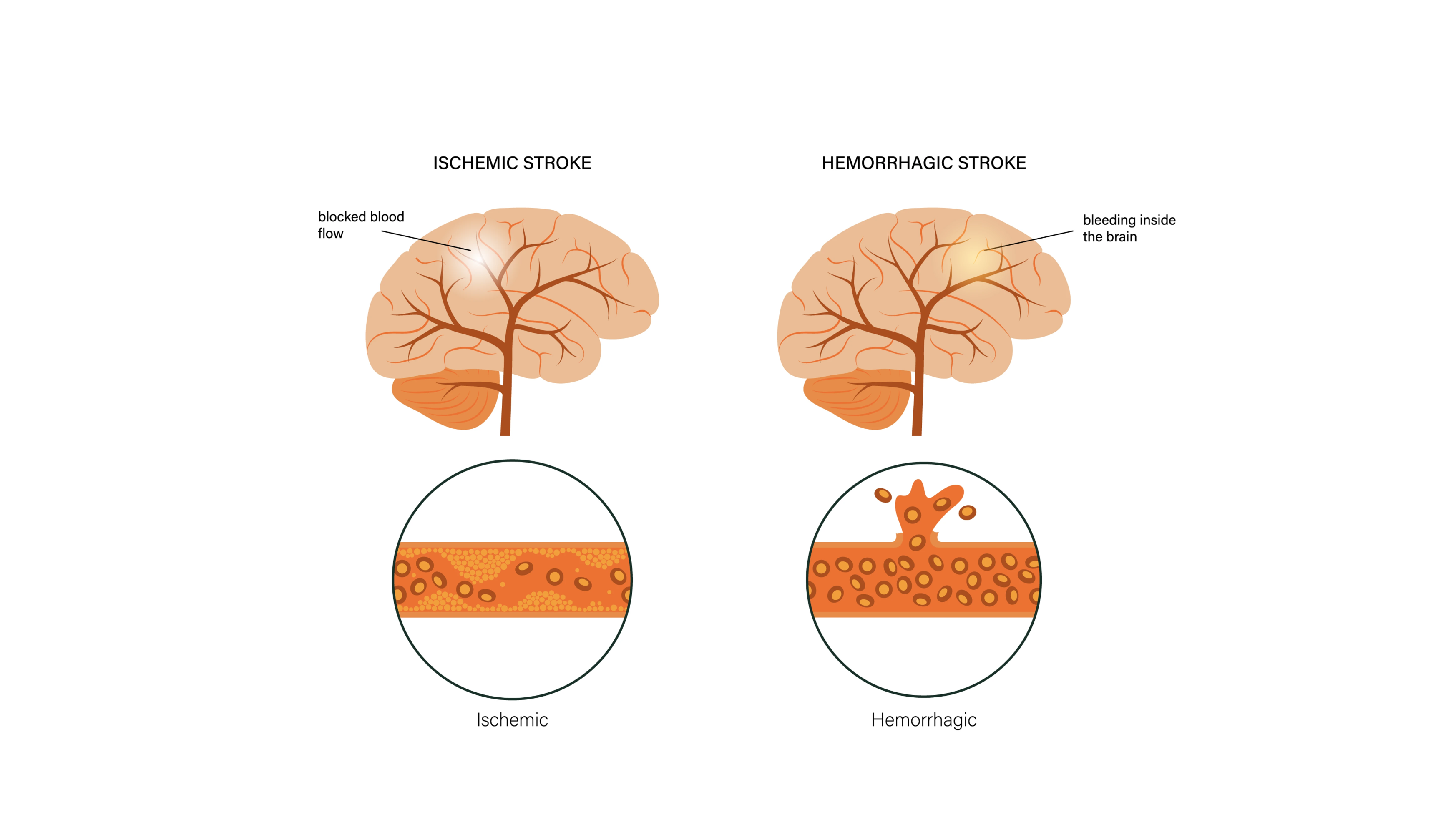 Two_kinds_of_stroke_Illustration_FWD.png